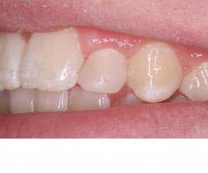 After using a boding technique, Foundations of Health Dental Care, Dentist St. Joseph, MO