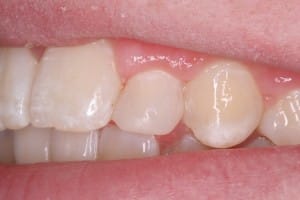 Dental work, after photo using bonding, Foundations of Health Dental Care, Dentist St. Joseph, MO