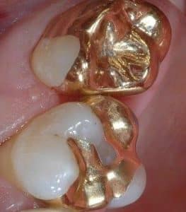 Gold inlays after it is placed by Foundations of Health Dental Care, St. Joseph, MO