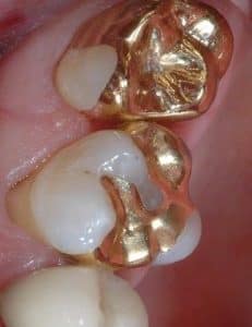 Gold inlay placed by Foundations of Health Dental Care, St. Joseph, MO