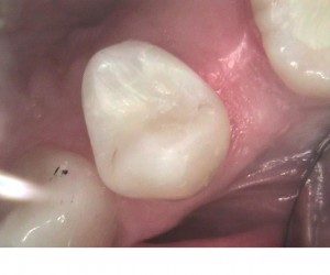 Photo of composite after silver filling was removed, Foundations of Health Dental Care, Dentist St. Joseph, MO