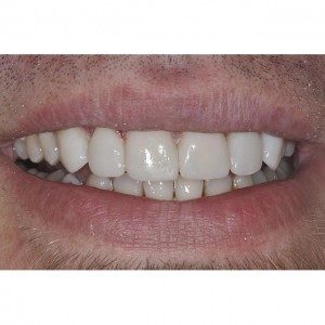 Photo after dental veneers, Foundations of Health Dental Care, Dentist St. Joseph, MO, 3815 Beck Road, St.Joseph, MO, 64506