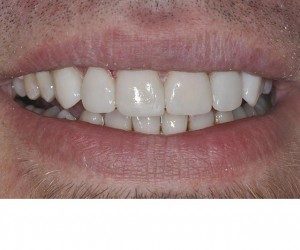 After using veneers to improve the spaces in a smile, Curry and Taylor DDS, 3815 Beck Road, St.Joseph, MO, 64506