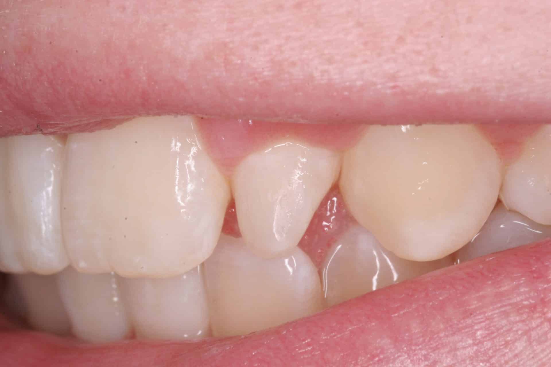 Photo of tooth before bonding technique, Curry and Taylor DDS, 3815 Beck Road, St.Joseph, MO, 64506