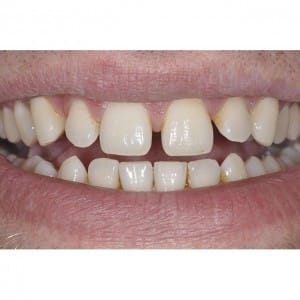 Before photo for dental Veneers Foundations of Health Dental Care, Dentist St. Joseph, MO, 3815 Beck Road, St.Joseph, MO, 64506