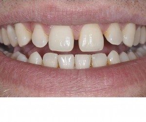 Before using veneers to improve the spaces in a smile, Foundations of Health Dental Care, Dentist St. Joseph, MO
