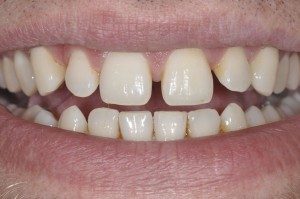 Before veneers are placed by Foundations of Health Dental Care, Dentist St. Joseph, MO