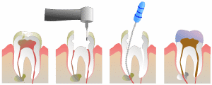 A crown is used after a root canal has been done. Our practice has restorative dentists who place crowns for patients.