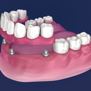 Example of snap in dentires that use implant post, FOUNDATIONS OF HEALTH DENTAL CARE (816) 233-0142.